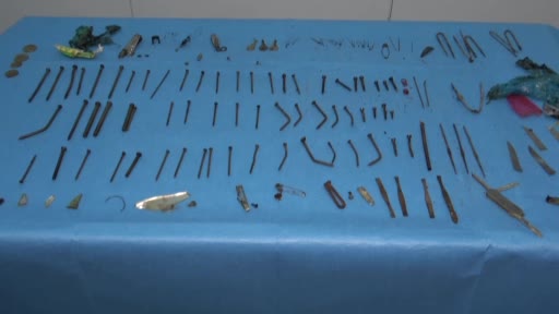 Doktorları şaşkına çeviren ameliyat: Midesinden 158 parça metal çıktı