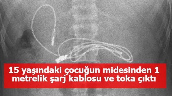 15 yaşındaki çocuğun midesinden çıkanlar şaşırttı